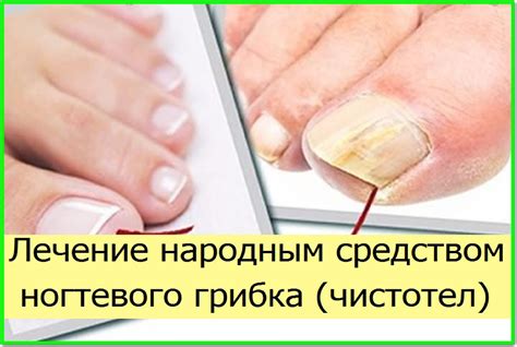 Как применять Звездочку от грибка ногтей