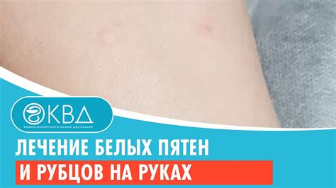 Лечение белых нитью