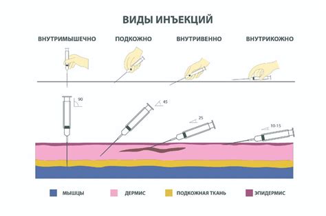Техника инъекции